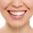 Whitening